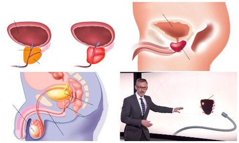 gesunde und erkrankte Prostata